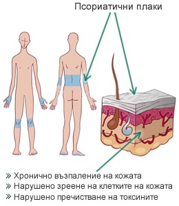 neopsoral-psoriasis-diagram_300.jpg
